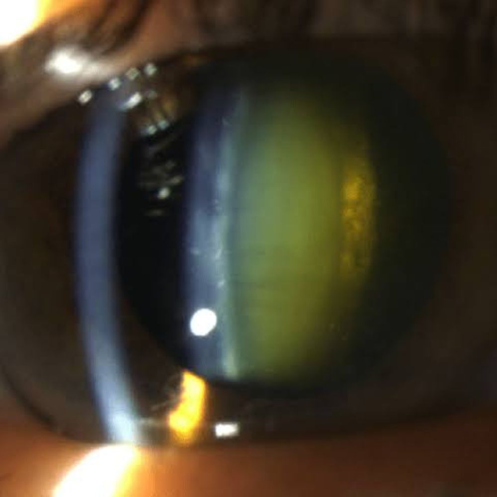 Cataract Surgery