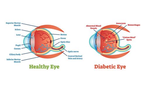 Diabetic Eye Disease Management