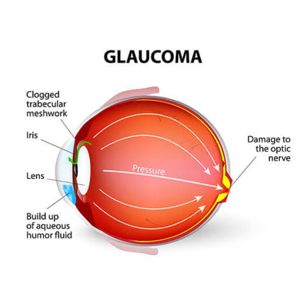 Glaucoma Care