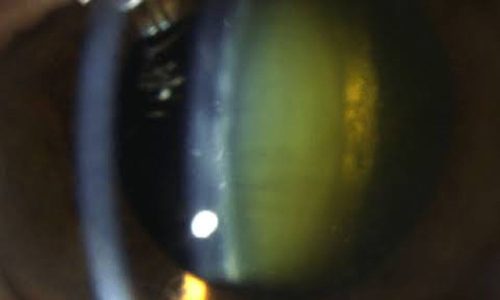 Cataract Surgery